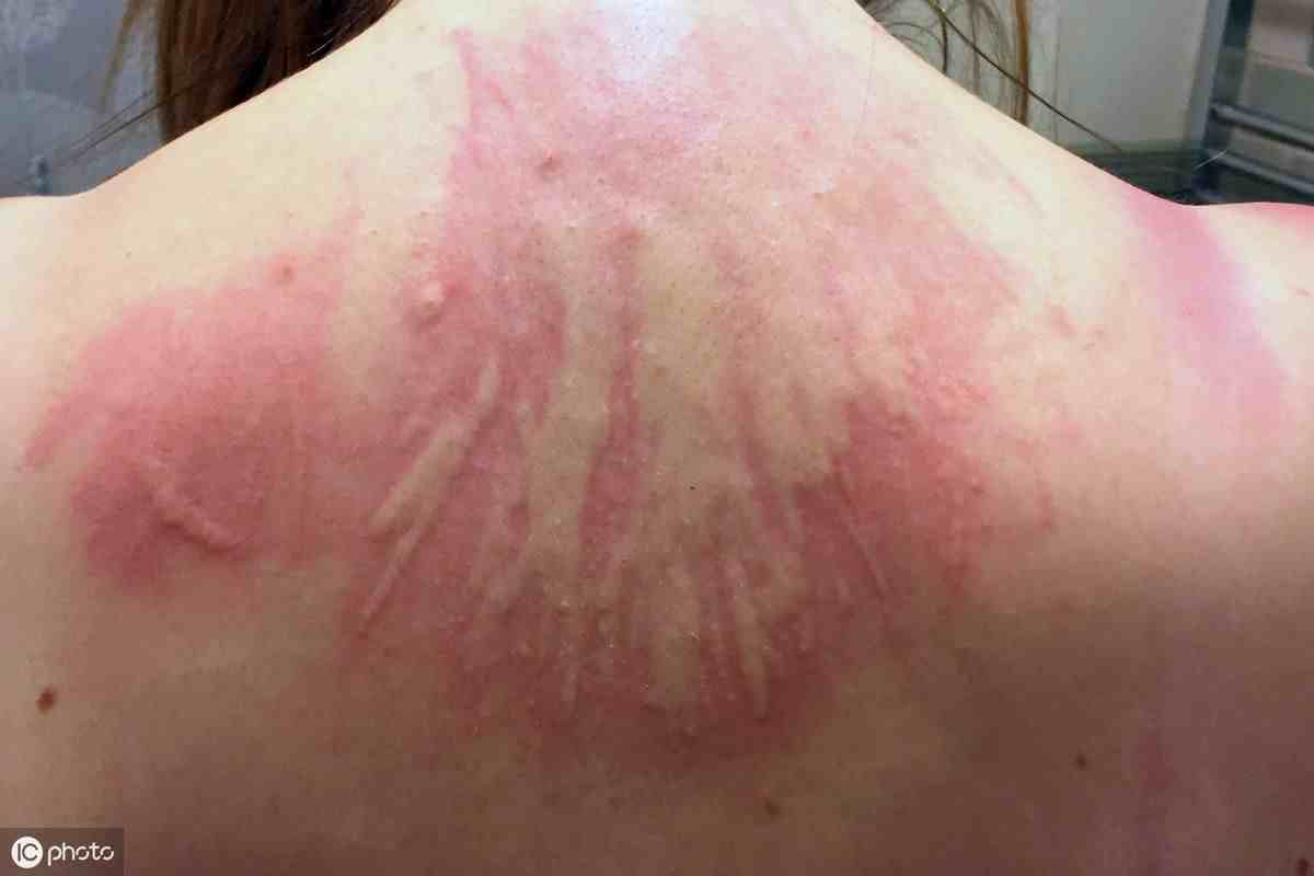 荨麻疹传染吗(荨麻疹到底会不会传染)