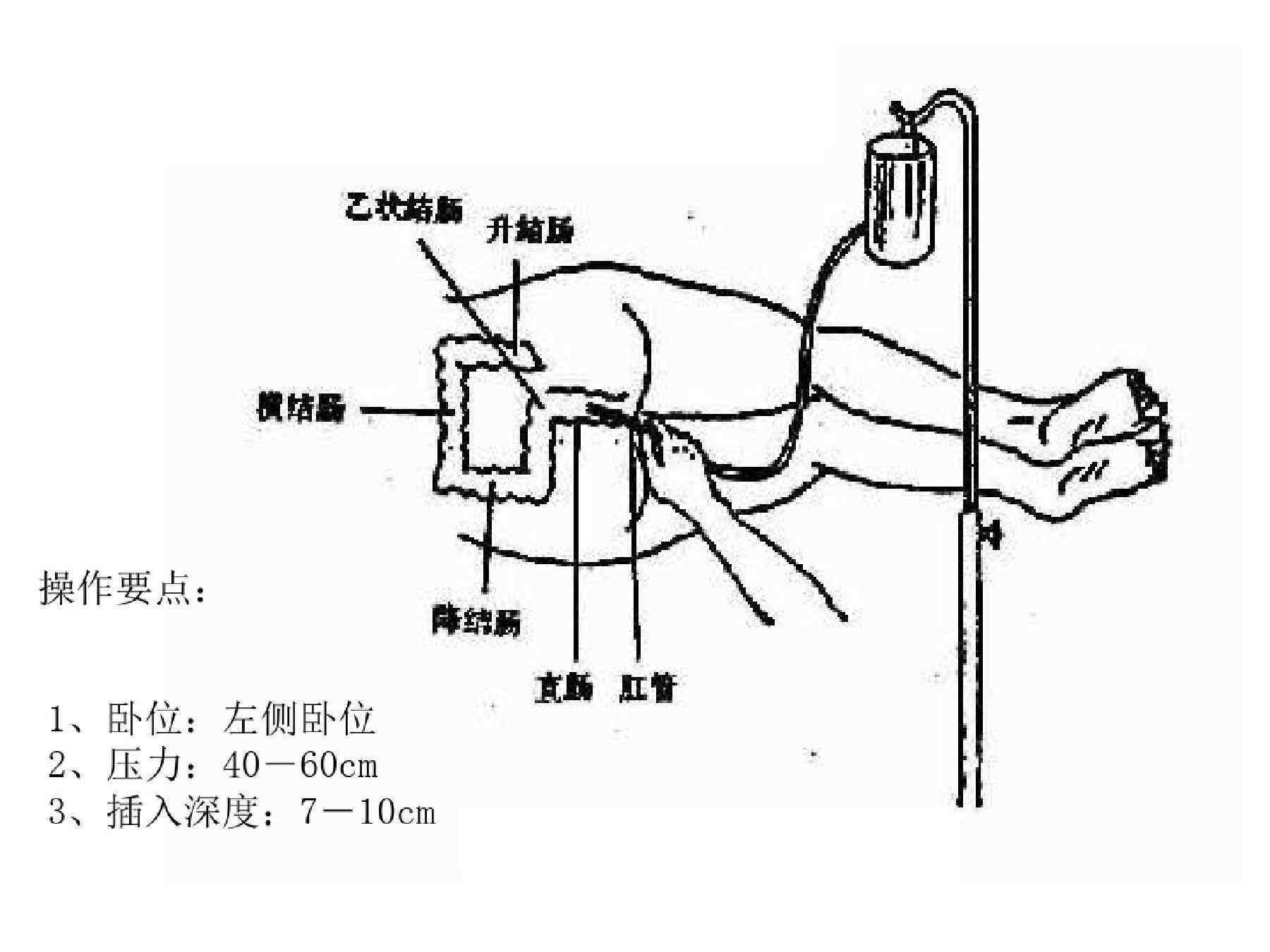 保留灌肠什么是中药保留灌肠法