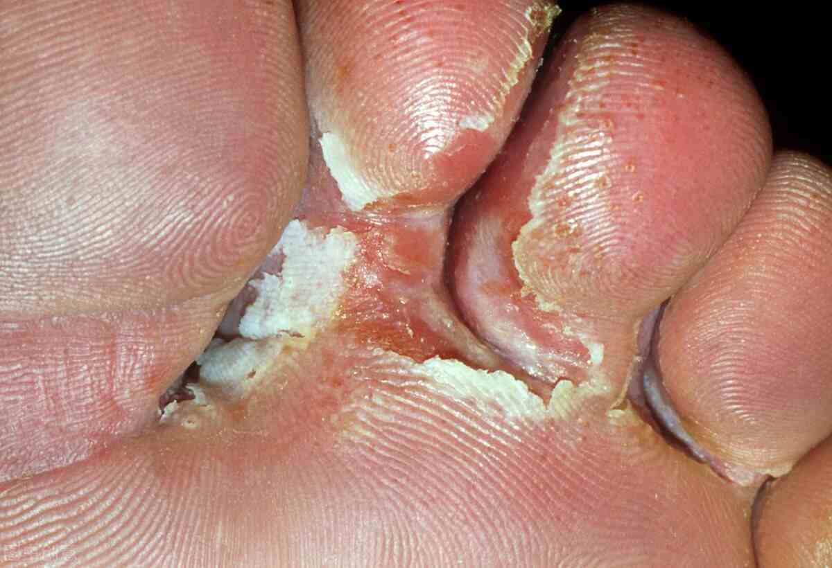 水泡脚气脚上起红疹水泡到底是脚气还是湿疹