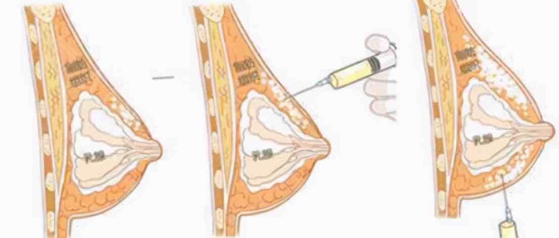 自体脂肪隆胸是怎么做的?