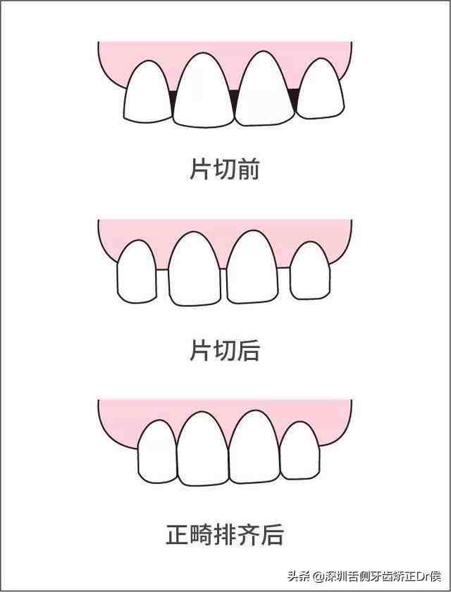 收牙缝要多久牙齿片切的缝隙多久可以收紧