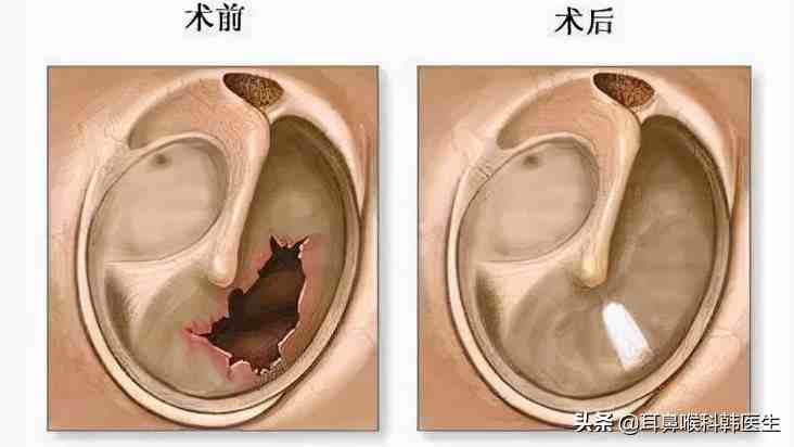 耳膜穿孔多久鼓膜穿孔能洗澡吗