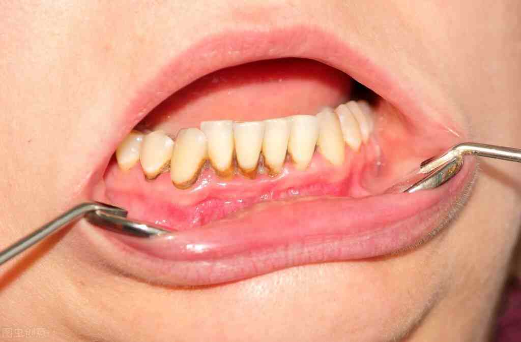 牙周炎是什么症状牙周炎和牙龈炎区别