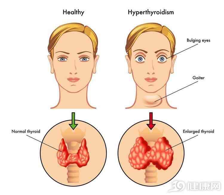 甲状腺有问题，哪些症状很明显？不瞒你说，是这三个