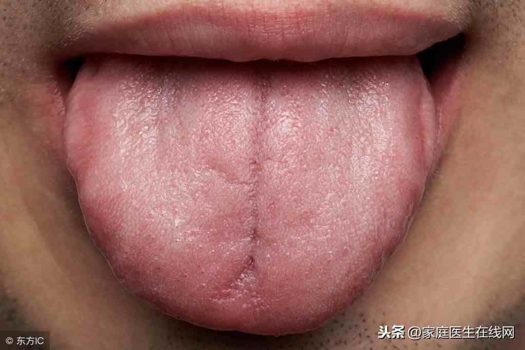 舌头裂口子是怎么回事？可能是这些情况，还是去医院检查下