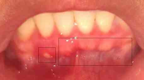 牙龈上有红色点点图片图片