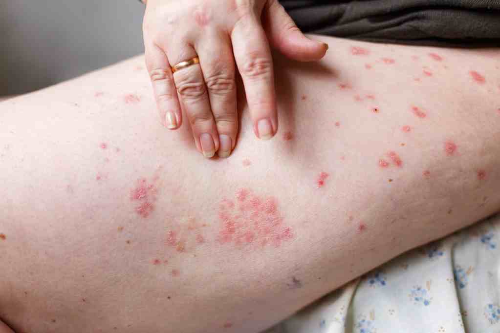湿疹是怎么引起的？湿疹能治愈吗？搞清原因对症治疗，远离它