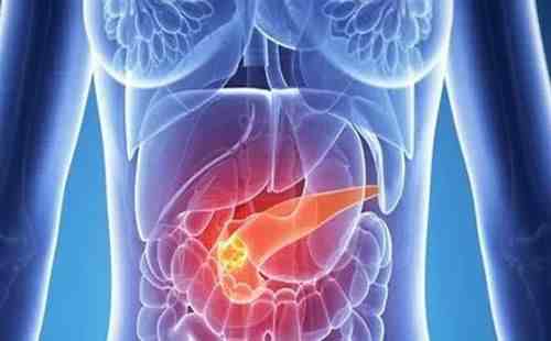胰腺癌是怎么引起的（常见的诱发胰腺癌