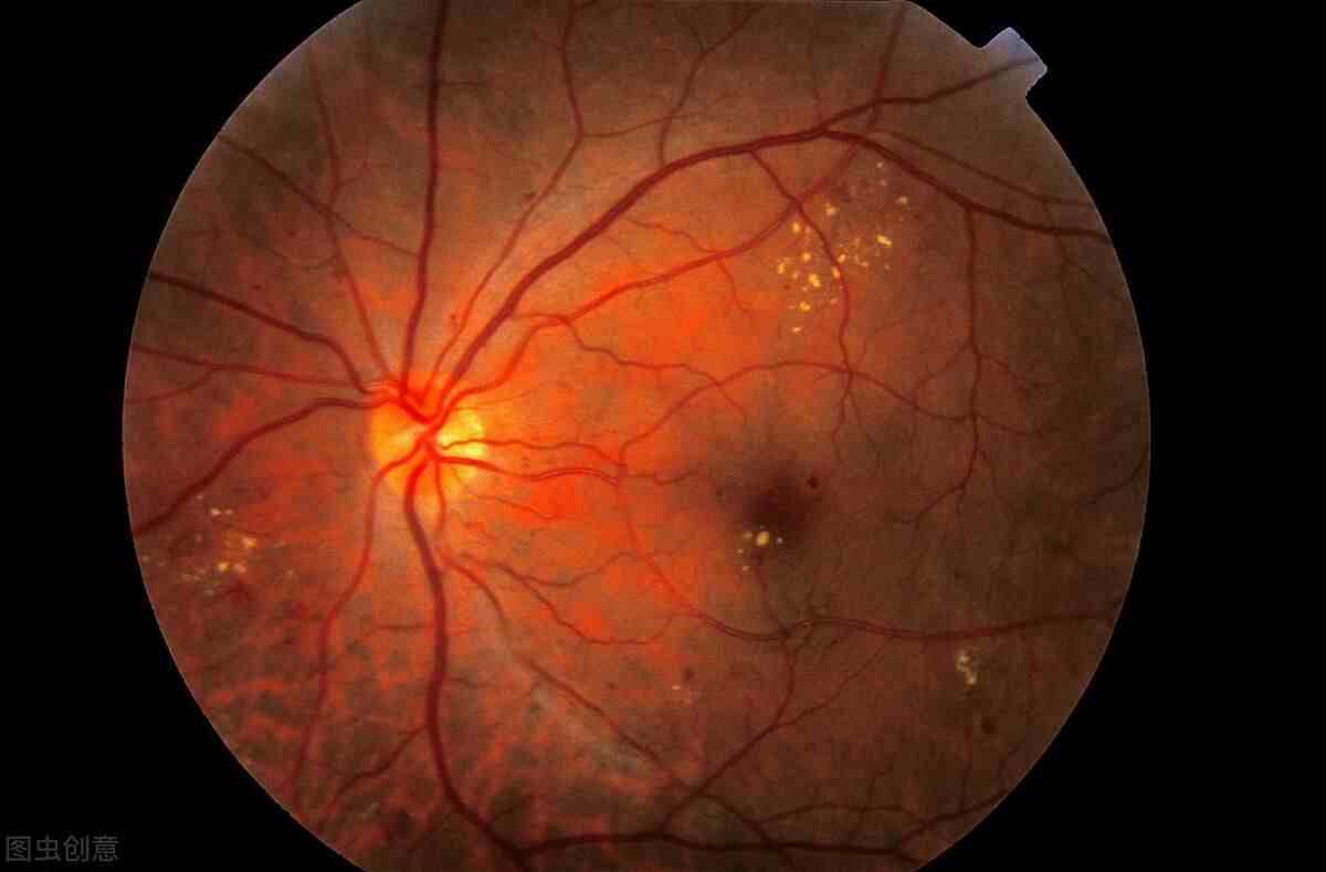 有哪些眼病可致盲呢？这4种眼病需警惕，及早治疗是关键