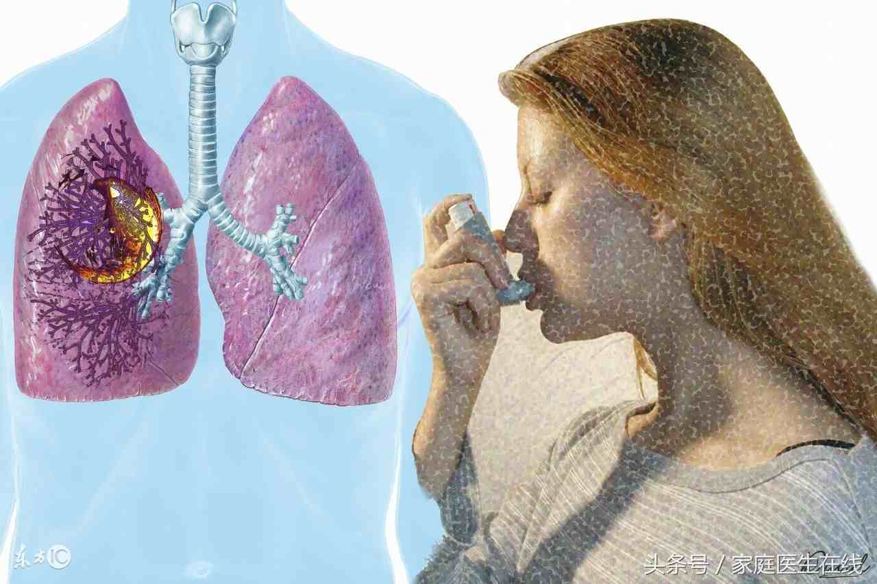 孟鲁司特钠能用于哮喘发作吗?呼吸科医生只说了一句大实话