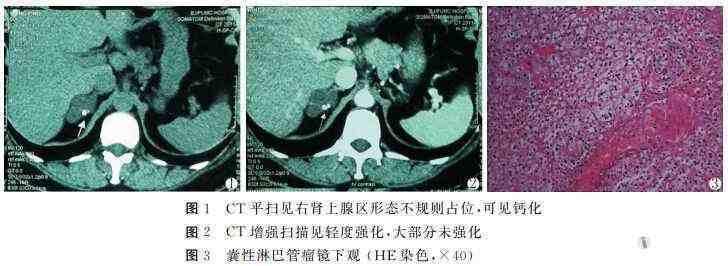 右肾上腺囊性淋巴管瘤1例