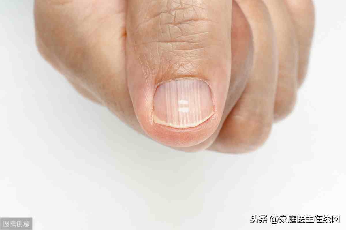 大拇指指甲上有竖纹|指甲有竖纹是怎么回事？