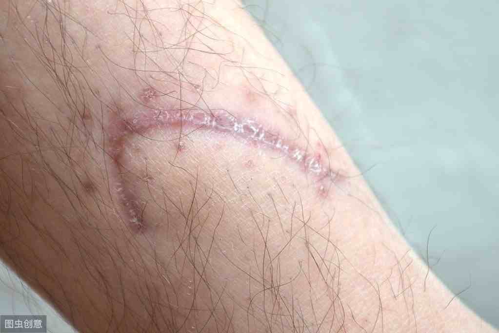 胥肖琴医生科普：如何去除手术疤痕，手术疤痕能去掉吗？