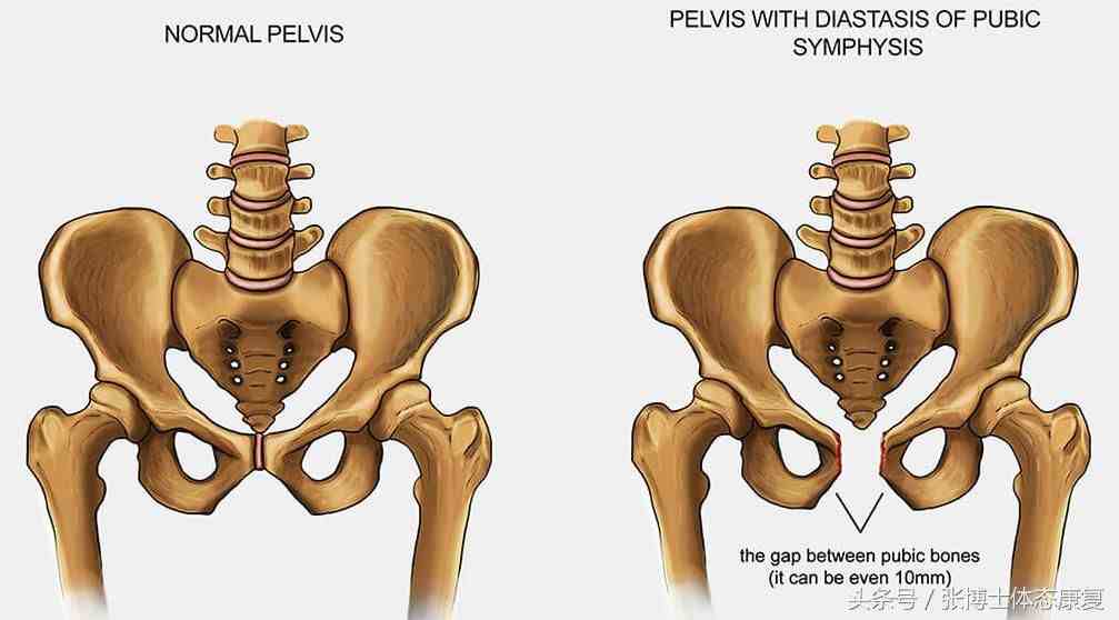 产前产后胯骨图图片