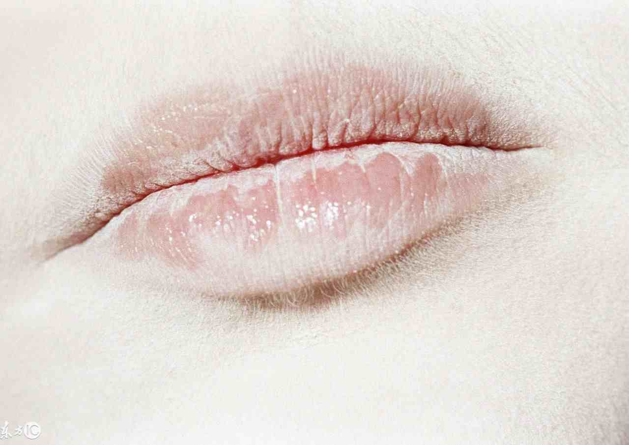 为什么嘴唇越舔越容易干裂？嘴唇起皮怎么去处理？