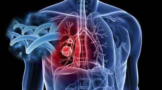 肺癌发现时往往是晚期，但其实肺癌早期有这五种征兆