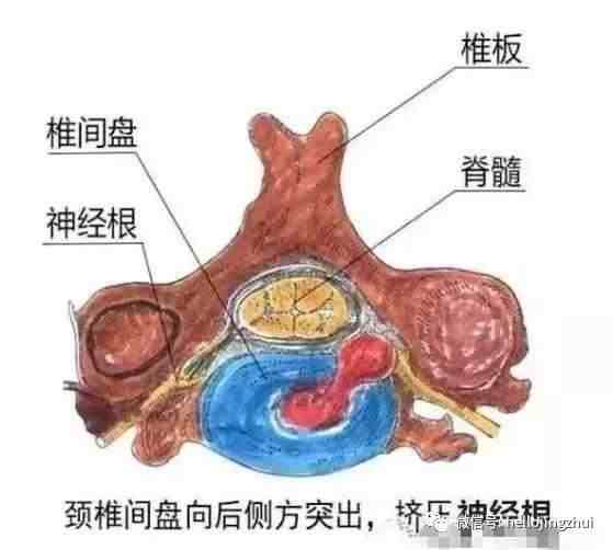 颈椎病，压迫了神经，又该咋整？附图详解