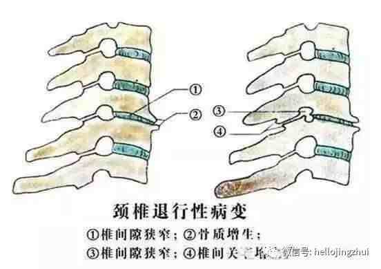 颈椎病，压迫了神经，又该咋整？附图详解