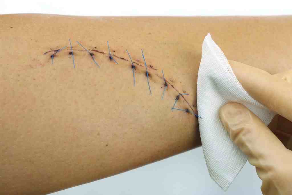 “大夫，医学那么发达了，我的伤口怎么还是针线缝的？疤多大啊”