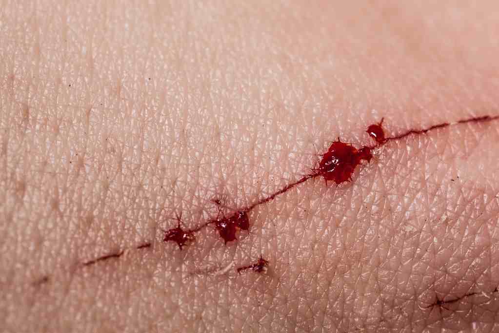 “大夫，医学那么发达了，我的伤口怎么还是针线缝的？疤多大啊”
