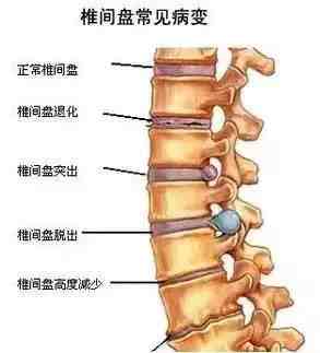 腰间盘突出最佳治疗|十天治好腰椎间盘突出