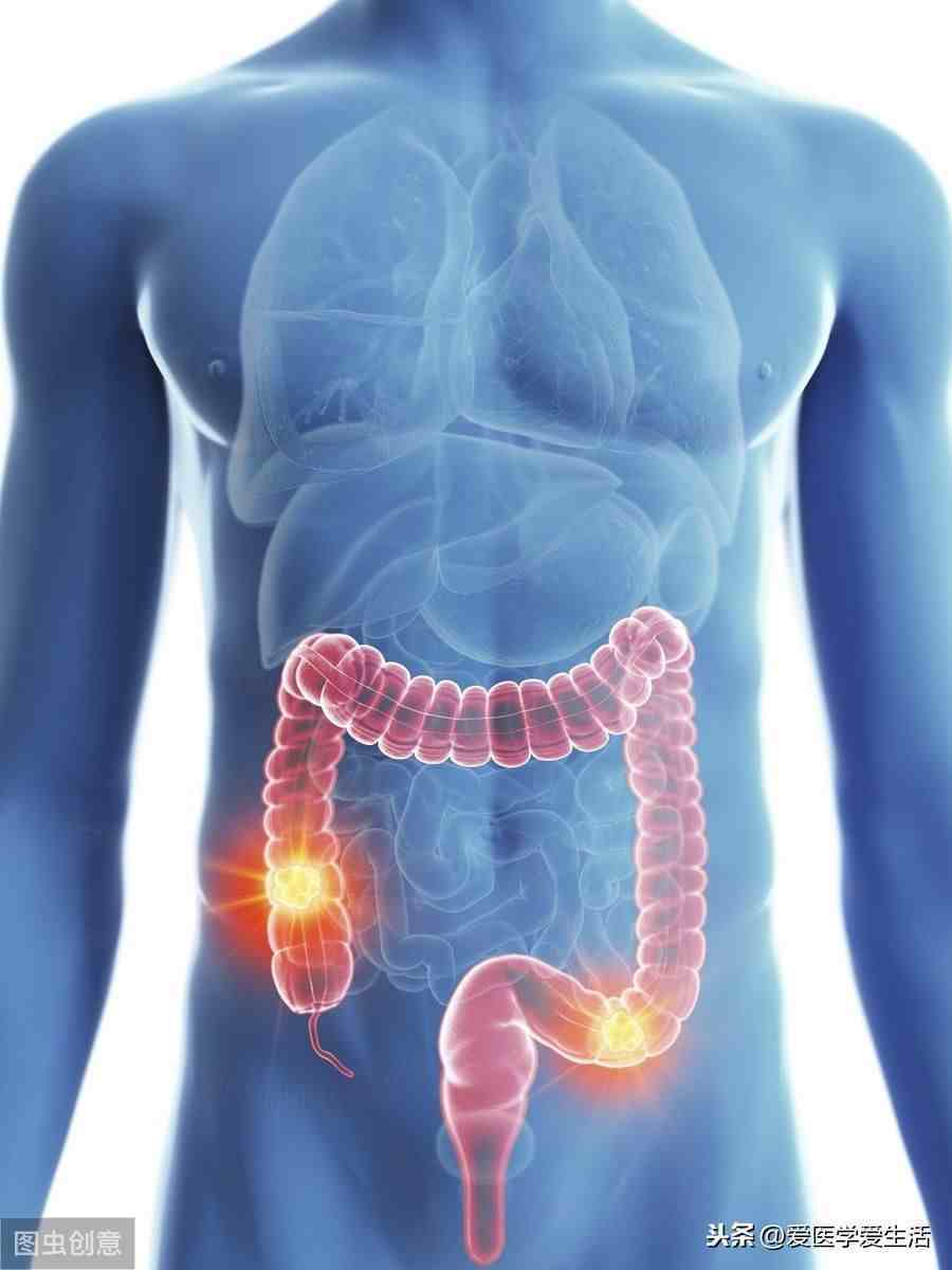 胃肠道间质肿瘤|胃肠道间质瘤的病因、诊断