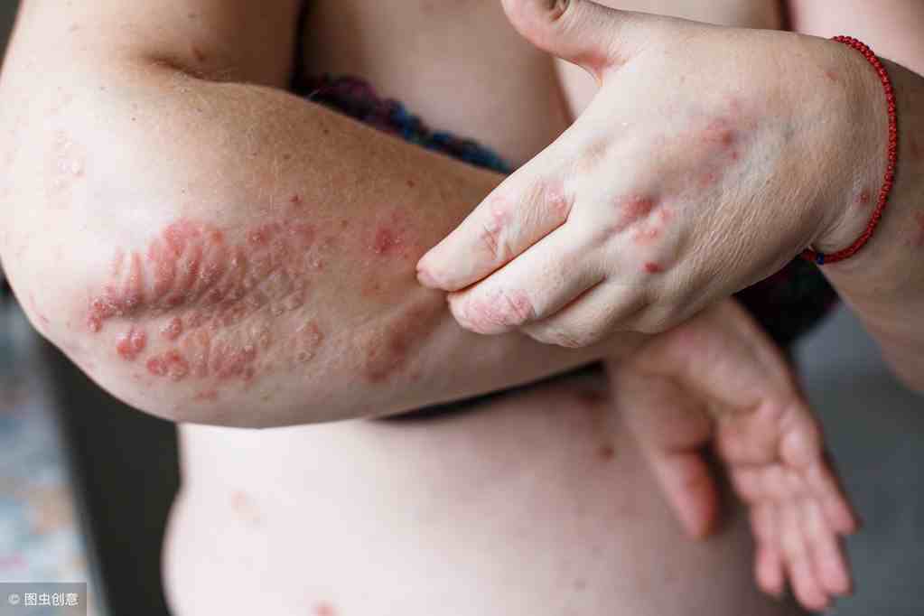 这7种常见皮肤病，很容易与牛皮癣混淆，快对号入座看看