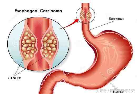 食道癌中医治疗|食管癌，中医是如何治疗的