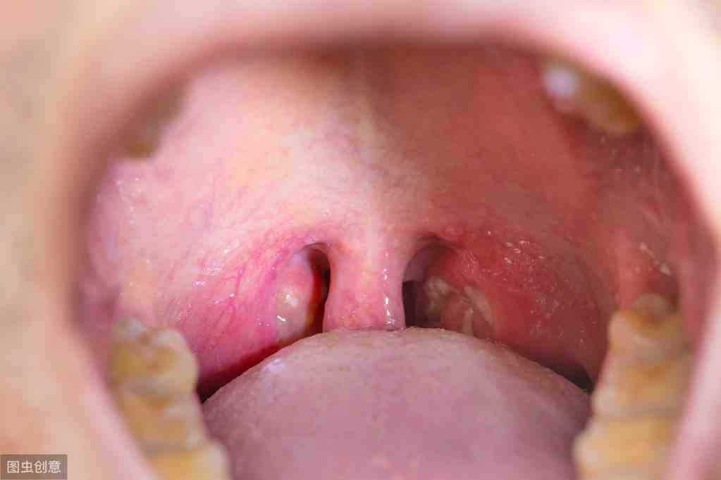 口臭是什么引起的|口臭，并非总因不讲卫生，还可能是6种疾病所致