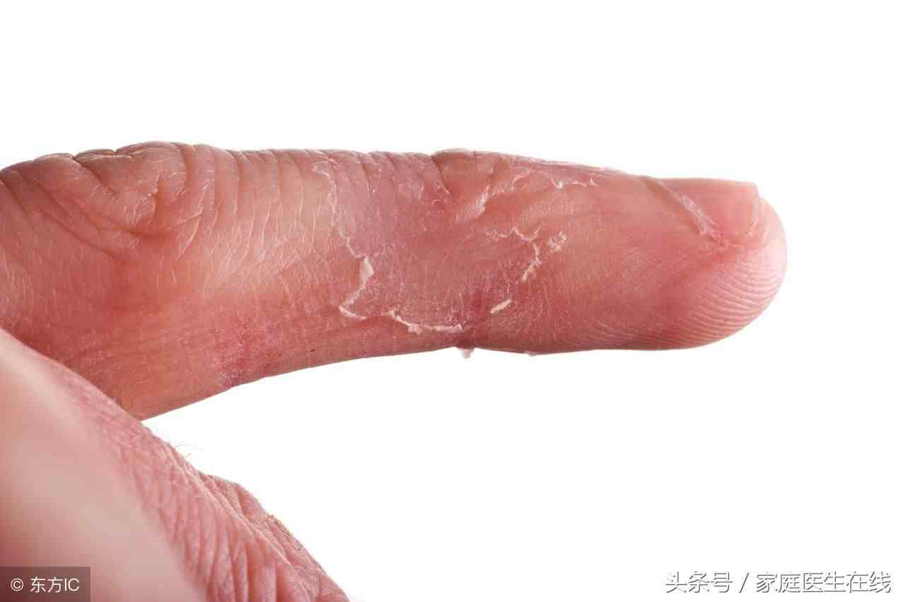手指脱皮是怎么回事|为什么你的手指总是会脱皮