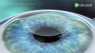 近视眼激光手术的原理到底是怎样的？有没有后遗症？