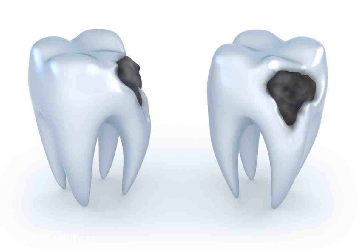 怎样预防龋齿|龋齿的有效预防方法