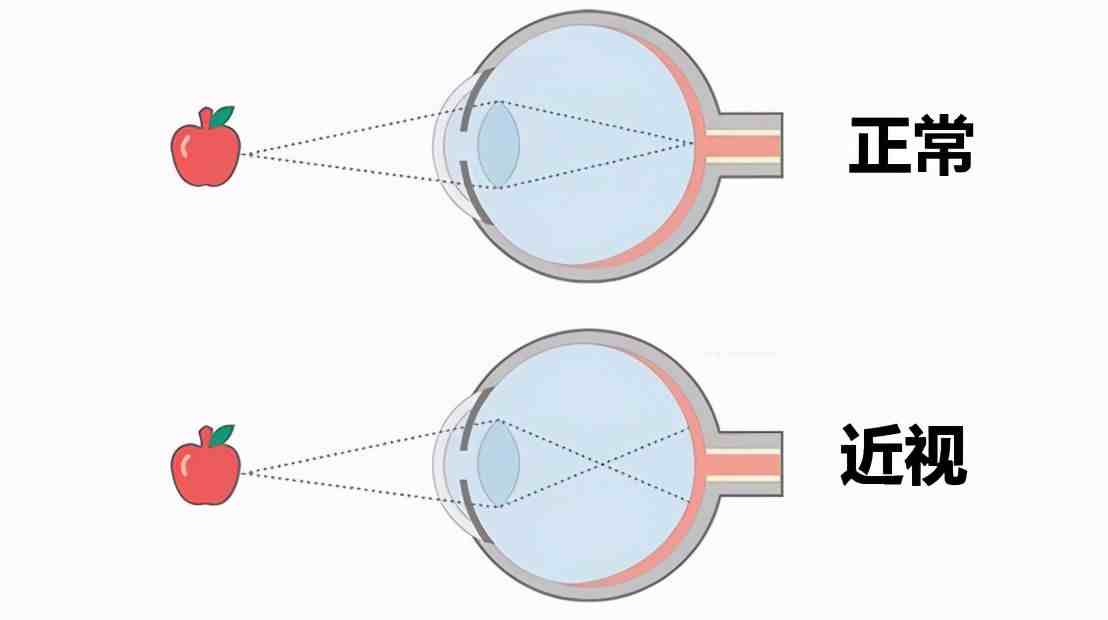 近视的危害|近视的危害您知道几个？