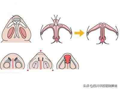 缩小鼻翼的方法|鼻翼缩小术三种常见方法