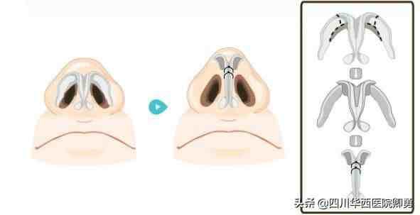 缩小鼻翼的方法|鼻翼缩小术三种常见方法