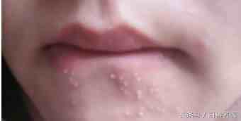 嘴巴周围长痘痘是什么原因|嘴巴周围为啥老长痘痘？