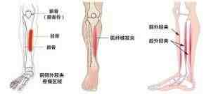 小腿骨膜炎的主要症状有哪些？