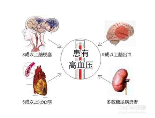 排瘀疗法治疗高血压和中风