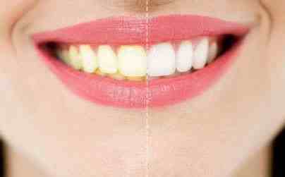 牙齿黄是什么原因|牙齿变黄的五大原因