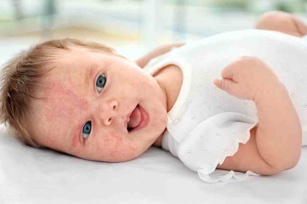 婴儿湿疹用什么药|常用于婴幼儿湿疹的五类药物