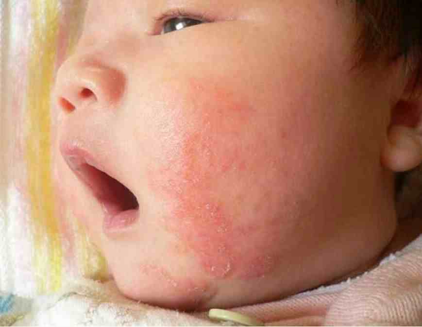 常用于婴幼儿湿疹的五类药物