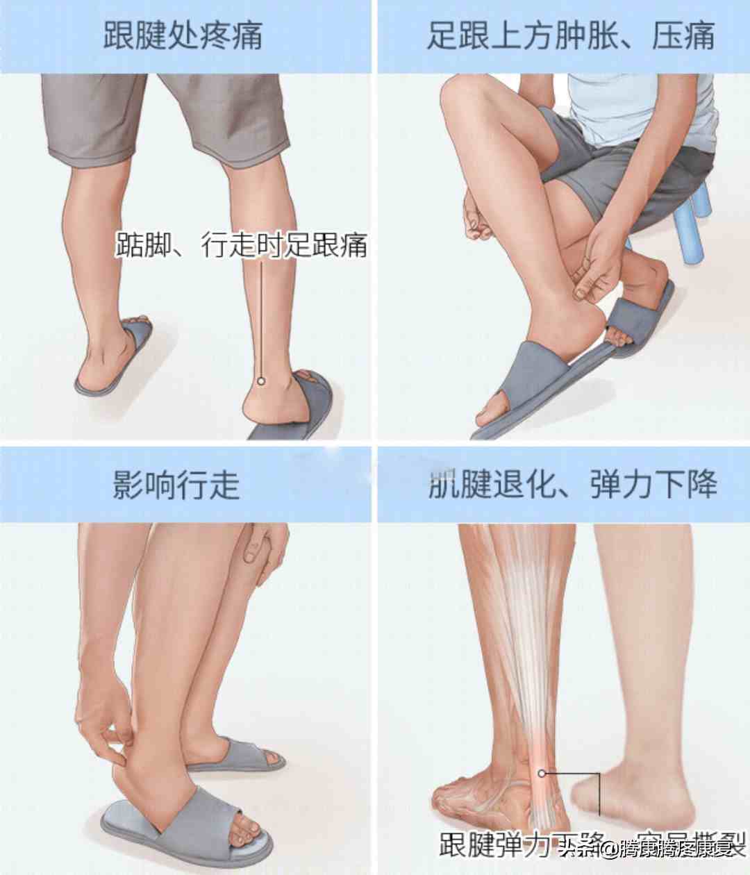 跟腱炎的分析与诊疗