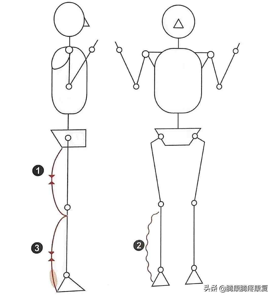 跟腱炎的分析与诊疗