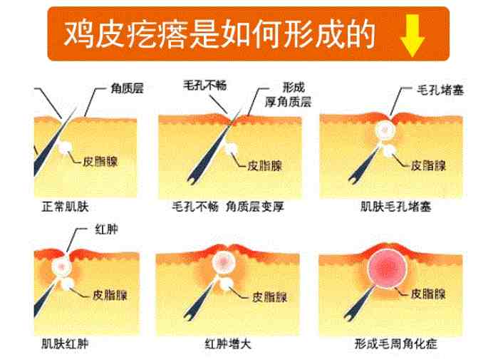 什么是鸡皮肤|鸡皮肤到底是个啥？