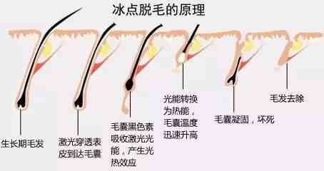 冰点脱毛要几次|冰点脱毛多久做一次比较好？