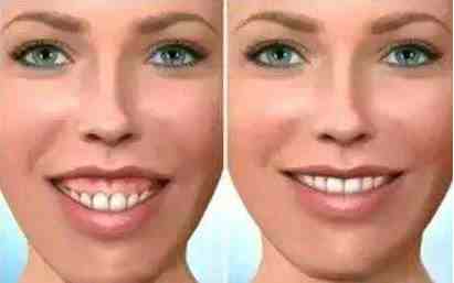 牙齿矫正能改变脸型吗？这3种情况对面容影响很大，矫正前要注意