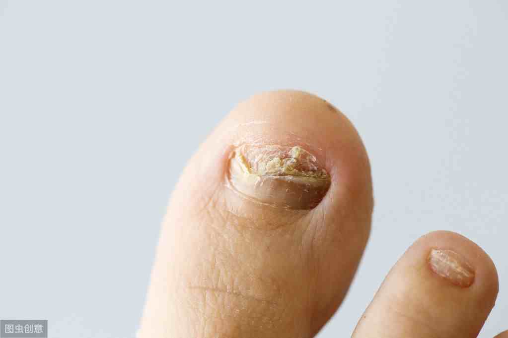 正确认识灰指甲，医生：六种最容易被误认为灰指甲的变化