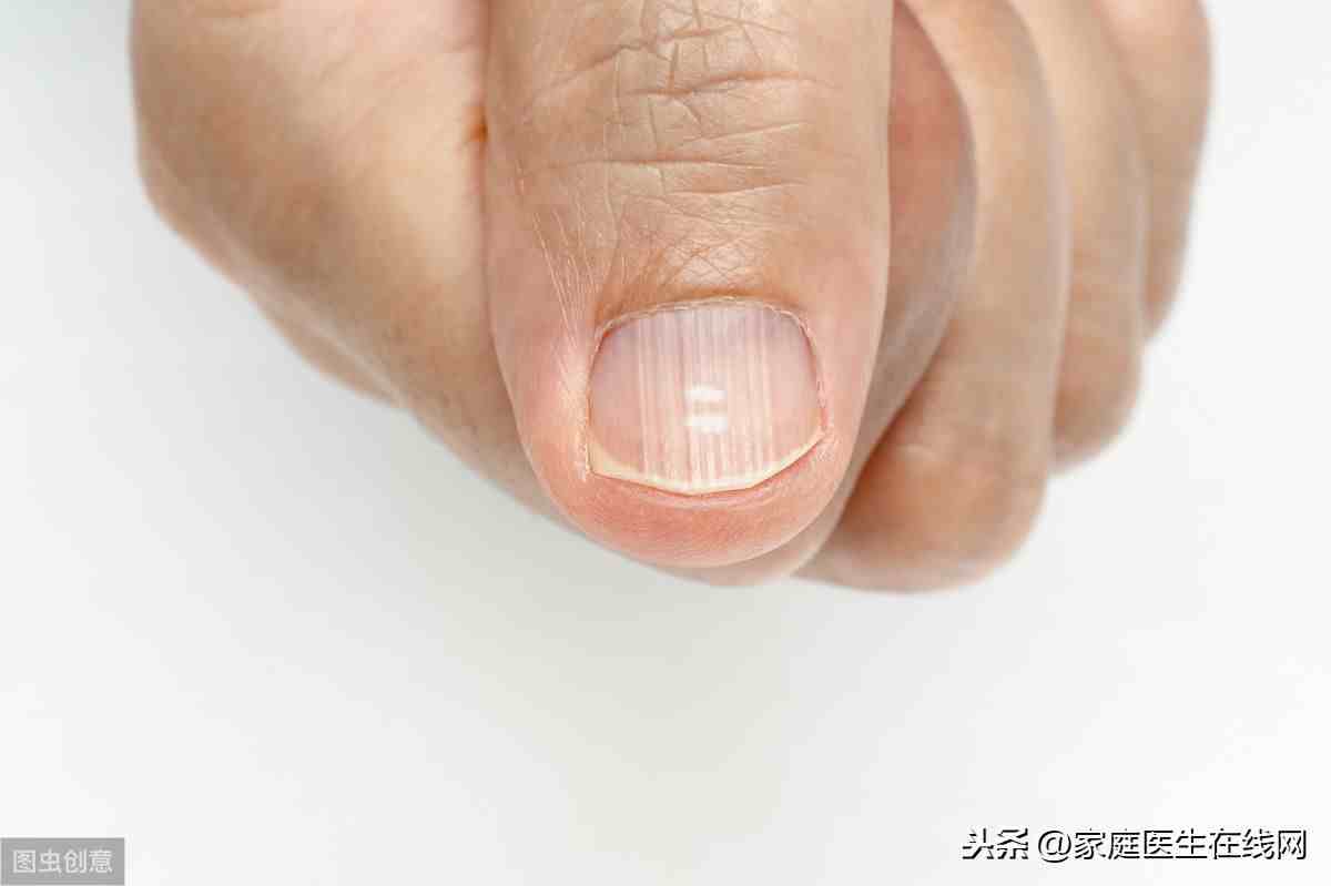 手指甲上有竖纹|指甲有竖纹是怎么回事？