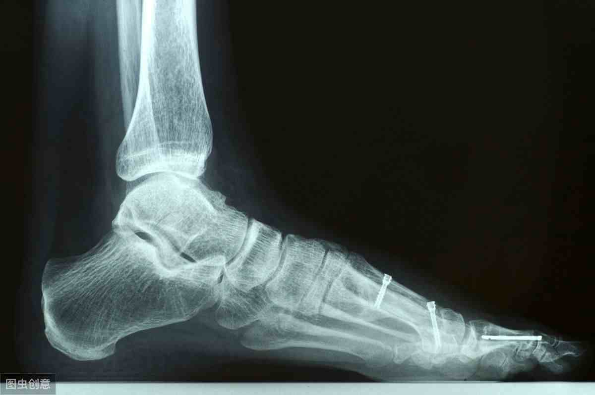 脚跟骨刺的治疗方法|足跟骨刺的治疗方法是什么？