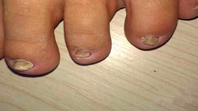 脚趾甲发黄变厚怎么办？这样清洁指甲可有效治疗